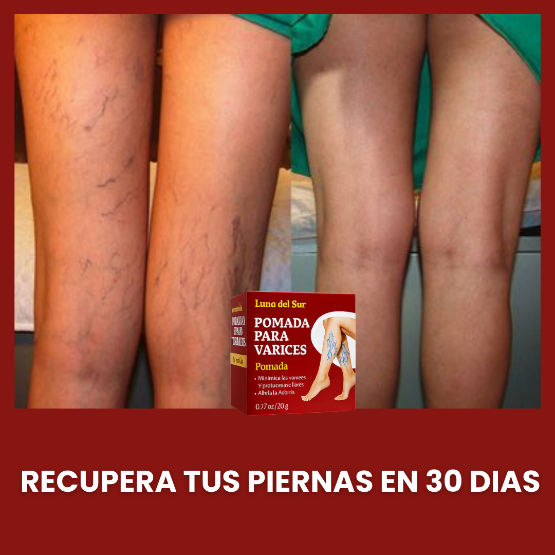 VARITREX / CREMA ELIMINA VARICES / ALIVIO EN 30 DIAS / OFERTA 🎁
