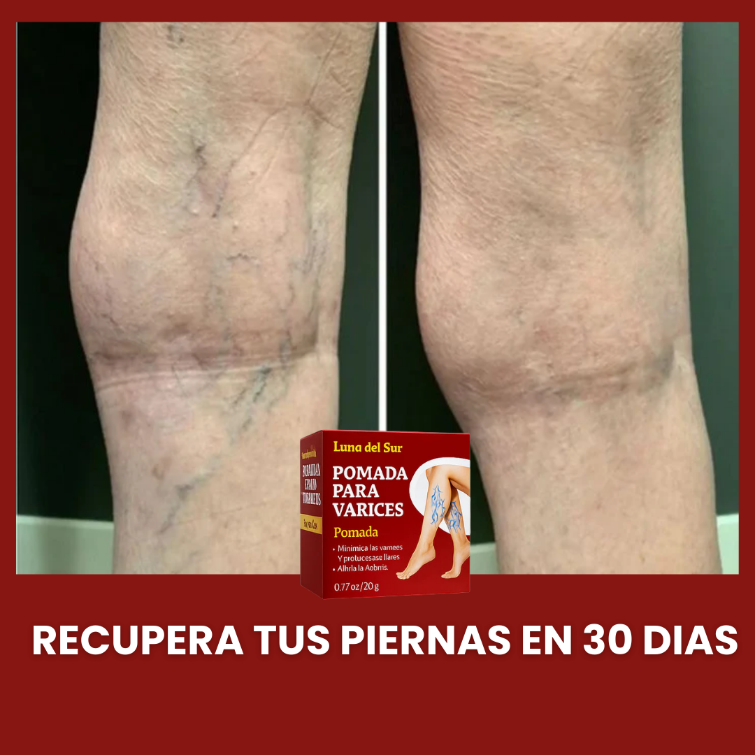 VARITREX / CREMA ELIMINA VARICES / ALIVIO EN 30 DIAS / OFERTA 🎁