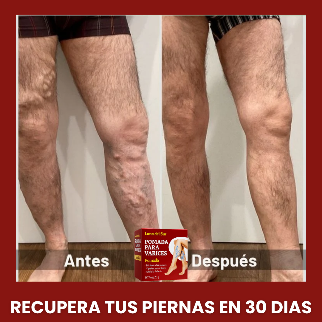 VARITREX / CREMA ELIMINA VARICES / ALIVIO EN 30 DIAS / OFERTA 🎁