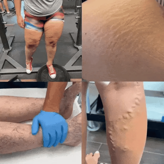 VARITREX OFERTA 2X1 / CREMA ELIMINA VARICES / ALIVIO EN 20 DIAS / PAGUE 1 RECIBA 2🎁