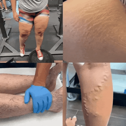 VARITREX OFERTA 2X1 / CREMA ELIMINA VARICES  / ALIVIO EN 20 DIAS / PAGUE 1 RECIBA 2🎁