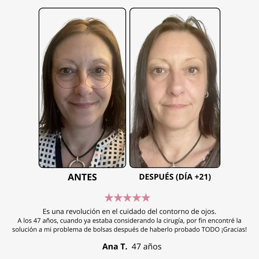 WOMBEA®  Crema de luz roja para el contorno de ojos
