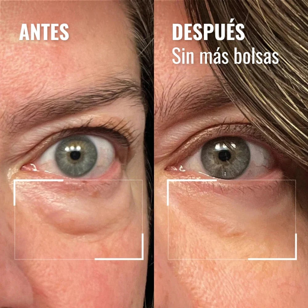 WOMBEA®  Crema de luz roja para el contorno de ojos
