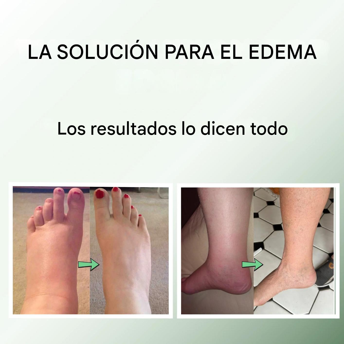 Piernas Ligeras al Instante: Miracle Balm™ Para Piernas y Tobillos Hinchados. 50%OFF